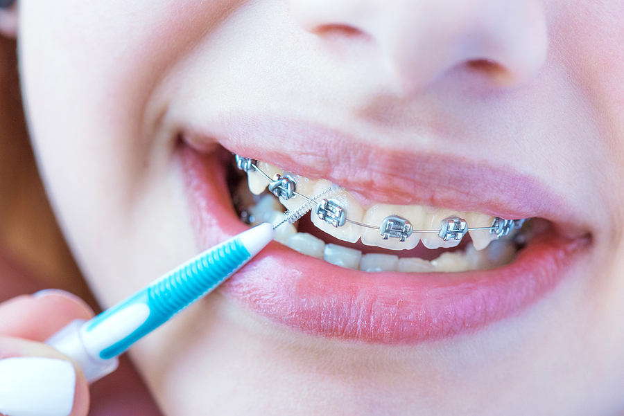 Close up female teeth with braces and interdental brush for dent