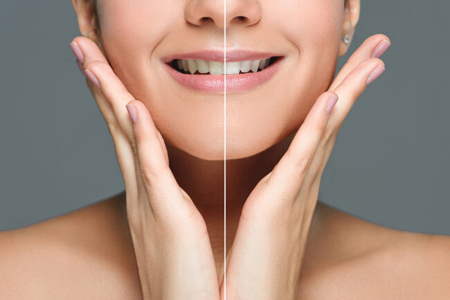 Partial View Of Smiling Woman With White Teeth Isolated On Grey,