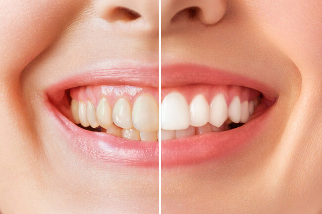 Perfect Healthy Teeth Smile Of A Young Woman. Teeth Whitening. D