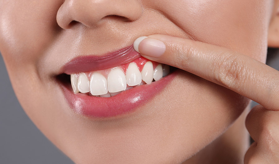 Teeth Whitening